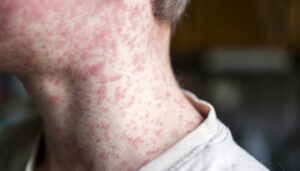 Photo of person with measles rash on their neck